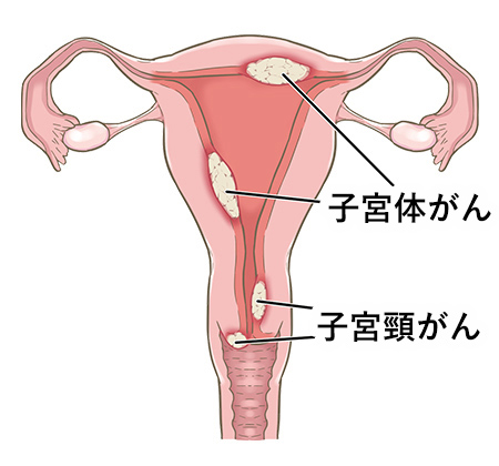 子宮がんってどんな病気？