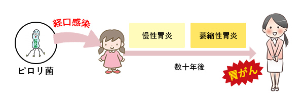 胃がんのほとんどは、ピロリ菌感染が原因